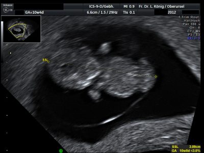 The first ultrasound screening takes place in the 9th–12th week of pregnancy. Important information about embryonic development can already be obtained here.