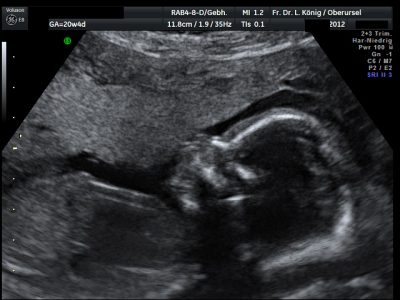 Das zweite Screening findet in der 19.–22. SSW statt. Jetzt können auch schon die inneren Organe dargestellt werden.