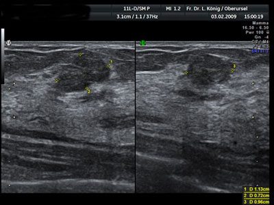 This image shows a benign, smooth-bordered fibroadenoma.