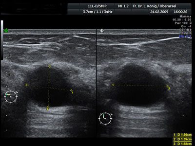 This is a fluid-filled cyst. This can be seen particularly well on ultrasound and is almost always benign.