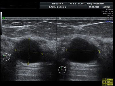 Hierbei handelt es sich um eine flüssigkeitsgefüllte Zyste in der Brust. Das ist im Ultraschall besonders gut zu erkennen und ist fast immer gutartig.