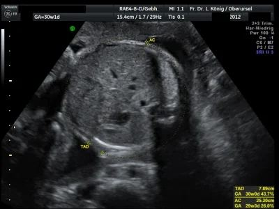 Darstellung des fetalen Abdomens (Bauch).