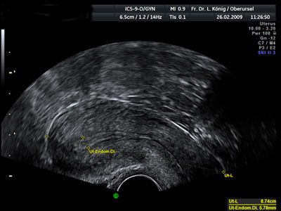 Here you can see your thickening of the uterine lining.